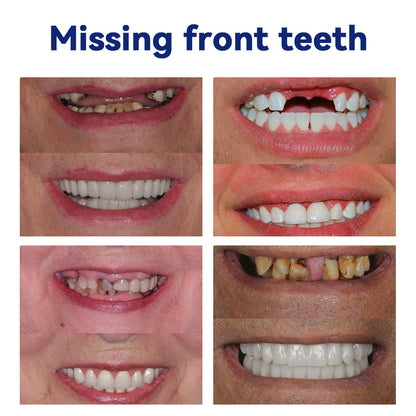 𝐁𝐢𝐤𝐞𝐧𝐝𝐚™ 𝐒𝐢𝐥𝐢𝐜𝐨𝐧𝐞 𝐑𝐞𝐥𝐢𝐧𝐞 𝐃𝐞𝐧𝐭𝐮𝐫𝐞 𝐒𝐞𝐭🧡 (👩‍🔬Recognized by the Australian Dental Association (ADA) and approved by the TGA）