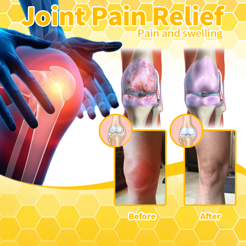 ✨Aeehfeng™ Bee Venom&Turmeric Arthritis Therapy Cream—Specializing in orthopedic conditions and joint pain